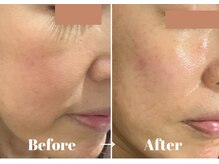 カラーリリー アンド ユン(Calla lily & yun)/ヒト幹細胞とカッサでたるみケア