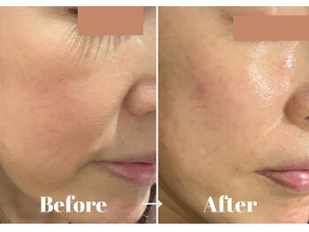 カラーリリー アンド ユン(Calla lily & yun)/ヒト幹細胞とカッサでたるみケア