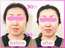 ホリハ整体院/*Before&After*　幹細胞美容鍼