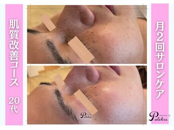 プルクレ 常磐町店(Pulchre)/シミが気になる