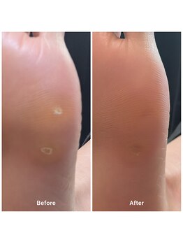 コフズ(Kofz)/魚の目もきれいになります