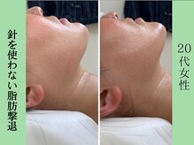 ソルニス(Solnis.)/小顔☆脂肪分解/ハイパーナイフ