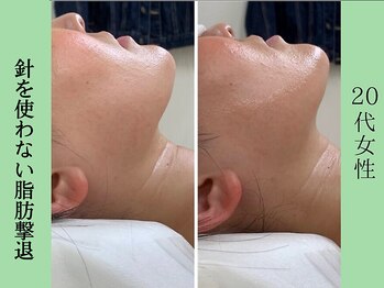 ソルニス(Solnis.)/小顔☆脂肪分解/ハイパーナイフ