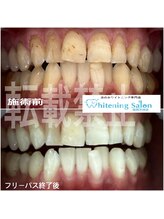 ホワイトニングサロン 福岡天神店/ホワイトニング