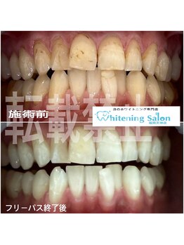 ホワイトニングサロン 福岡天神店/ホワイトニング