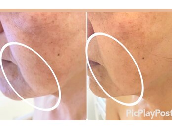 エステドブルー(Este de Bleu)/ビフォーアフター