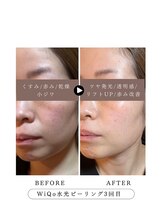 ラウレア(Laure'a)/毛穴洗浄/WiQo水光ピーリング