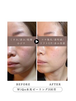 ラウレア(Laure'a)/毛穴洗浄/WiQo水光ピーリング