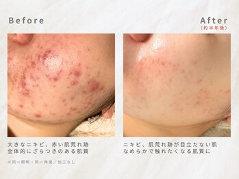 メレ(mele)/30代ニキビケア/肌荒れ跡・毛穴