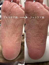フット角質ケア/かかとケア