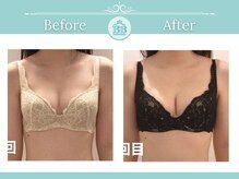 ベルビューティー(belle beauty)/【サイズアップ/C以下】症例写真