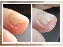 ルポ(REPOS)/深爪ケア