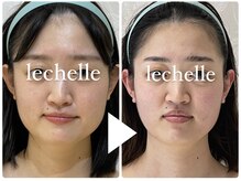 レシェルサロン(Lechelle Salon)/ハイパーナイフ小顔＋ブライダル
