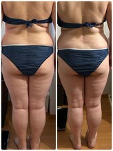 ヨサ パーク コアハート(YOSA PARK CORE HEART)/太もも