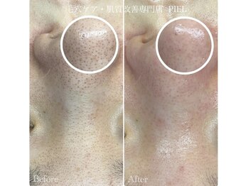 ピエル 北千住店(PIEL)/お痛みについて