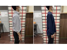 目黒もりおか整骨院/猫背矯正ビフォーアフター