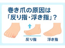 巻き爪じゅん 千葉駅前店/浮き指と巻き爪の深い関係とは？