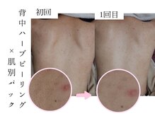 シェリー(Cheri)/【背中毛穴洗浄吸引/4step】