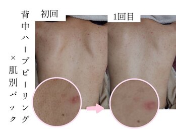 シェリー(Cheri)/【背中毛穴洗浄吸引/4step】