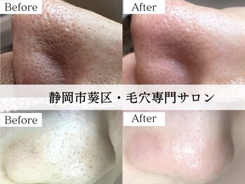 ジェリー(JERRY)の写真/【メンズ毛穴】男性特有の毛穴悩みに★毛穴エクストラクションでごっそり毛穴洗浄&皮脂抑制◎