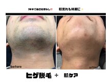 プリマプリート メンズ店/《ヒゲ脱毛》学割適用できます☆