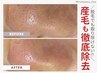 《2回目以降》毛穴エクストラクション〈全顔取り放題！〉　¥10000