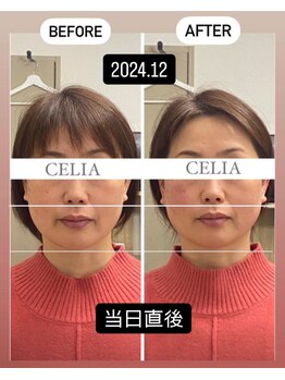 セリア(CELIA)/小顔/小顔矯正/リフトアップ