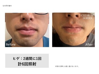 フェレザ 新潟(Felleza)/鼻下・あご下も楽々照射