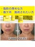 ７月【部分脂肪分解】輪郭.あご下.目元口元悩み★レモンボトル5CC/60￥40000
