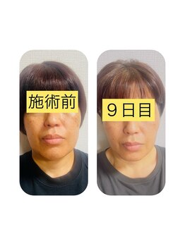 東洋経絡エステ アンド リラクゼーション/シミケア