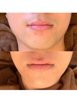 カイル 横浜(Kyle.)/メンズひげ脱毛[ヒゲ脱毛 眉毛]