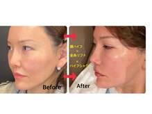 スペチアーレ 夙川/金糸シャワーは老け顔に効果的