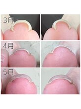 キャンディベース フクシマ(Candybase Fukushima)/巻き爪ケアもお任せください