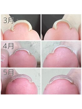 キャンディベース フクシマ(Candybase Fukushima)/巻き爪ケアもお任せください