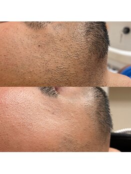 シャルム(Charme)/ヒゲ脱毛で男磨き