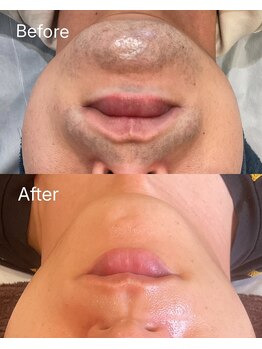 ステッリーナ(stellina)の写真/口コミ満足度☆5.0！知る人ぞ知るエステサロンでmen'sヒゲ美肌脱毛1回￥5000を体験♪