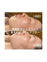 ヌーベルコピーヌ 五井店/諦めないで！美肌をゲット！