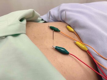 エムアンドエス鍼灸整骨院(M&S鍼灸整骨院)/電気鍼