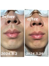 アンレーヴ/ひげ脱毛経過