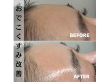 ベレア(BELEA)/おでこツルツルに♪形綺麗に♪