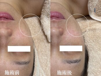 キーオブフェイス(Key of Face)/お悩み【たるみ】