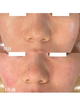 オレアグリーン 岡崎(OLEA green)/ホワイトハーブ5回