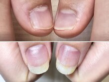 グラシュータン(gracieux temps)/深爪矯正