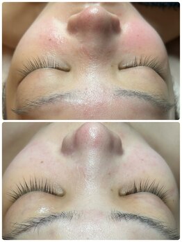 プレジール(Plaisir)/韓国ピーリング×肌管理1回