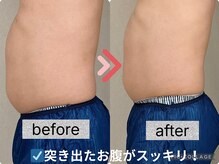 イヨヨ(iyoyo)/【痩身】Before After