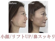 ラプリ 銀座店(Raplit)/隆鼻＋輪郭矯正40分10回