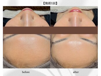 アン ビューティー(ann beauty)/施術1回【症例写真】40代