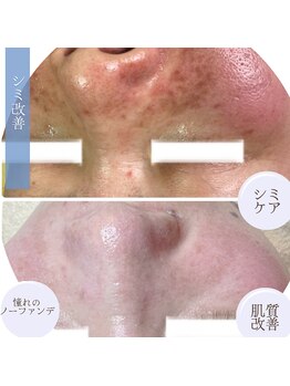 プリエ(Prier)の写真/<正しいケアと施術でしっかり改善★>しつこいシミを最速ケア◎劇的ビフォーアフターチェック♪