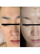 ピアーノ(PIANO)/エルモサハーブピーリング