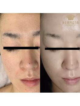 ピアーノ(PIANO)/エルモサハーブピーリング